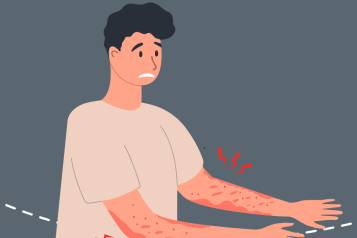 psoriasis